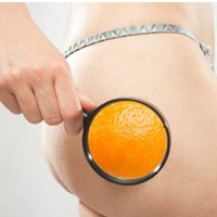 alt= Discover Everything You Need To Know About Cellulite